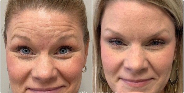 Botox Crows Feet and Eyebrow Lift Before And After