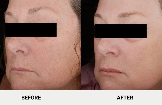 coolpeel before and after