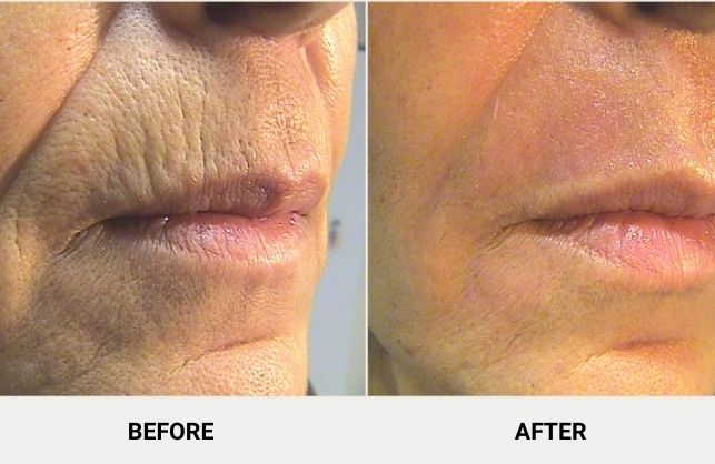 coolpeel before and after