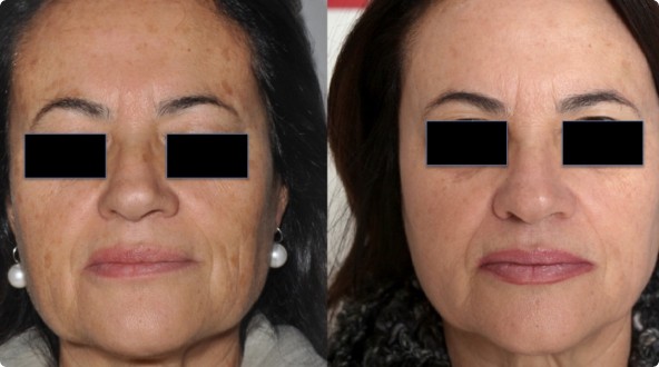 CoolPeel Before & After