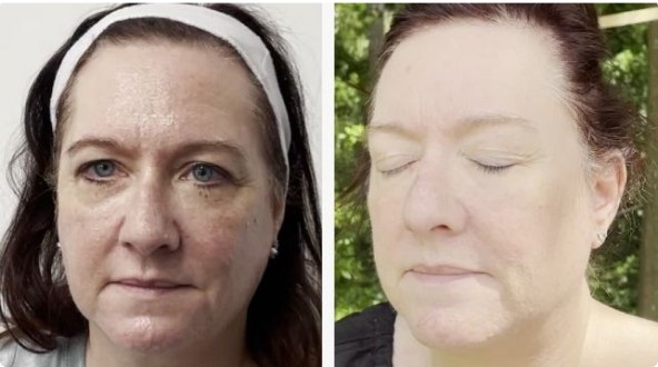 CoolPeel Before & After