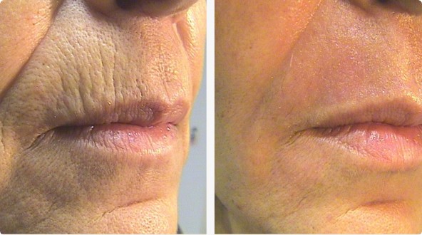 CoolPeel Before & After