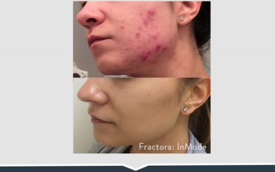 Fractora_AcneSkinboth