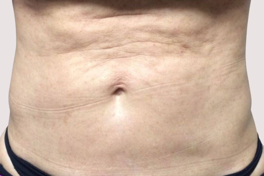 How to Prevent and Correct Uneven Areas in Your Belly After Liposuction