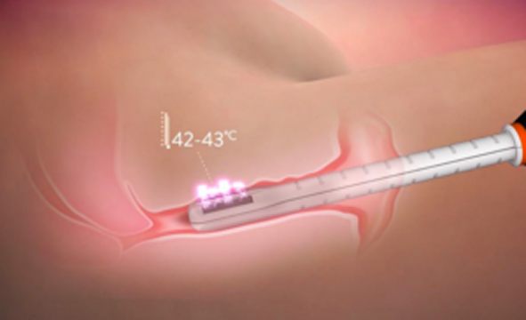 Insertion of the FormaV wand into the vaginal canal for RF energy treatment to stimulate collagen