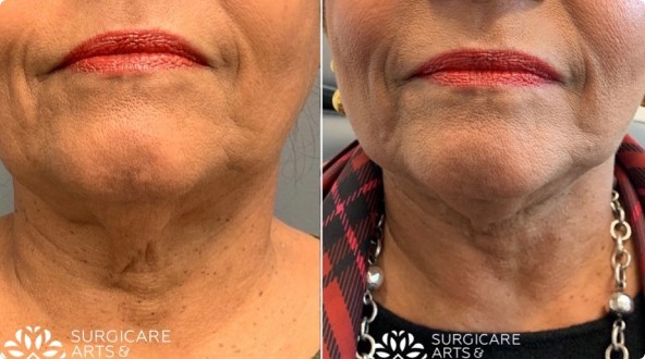 Facetite Neck Before And After