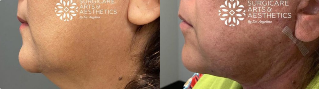 Facetite Procedure Results Chin, Neck, Jowls