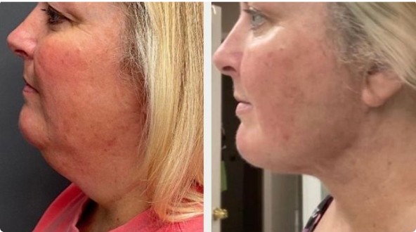Chin, Neck and Jawline Before And After Facetite Procedure