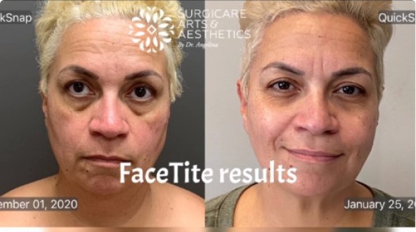InMode Facetite Before and After - Neck, Chin, Jowls, Under Eye