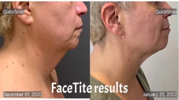 InMode Facetite Before and After - Neck, Chin, Jowls, Under Eye 2