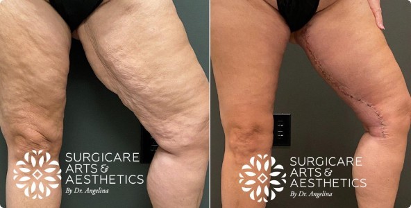 Thigh lift after weight loss before and after