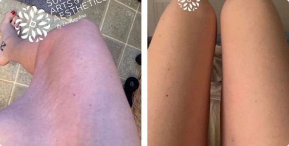 Inner Thigh lift Surgery Before and After Pictures