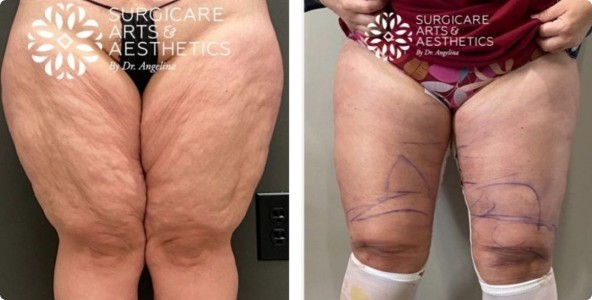 Amazing Pictures of Inner Thigh Lift Results