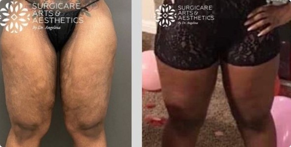 Before and After Inner Thigh Lift