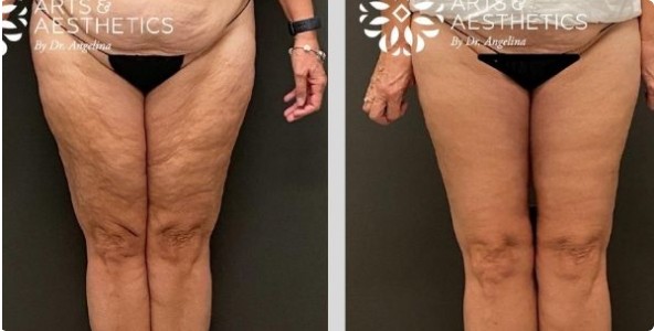 Anti-Aging Inner Thigh Lift Before and After