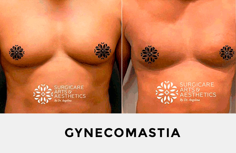 gynecomastia