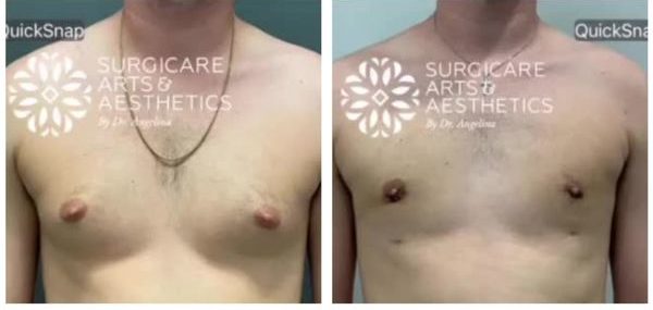 Vaser lipo gynecomastia before and after