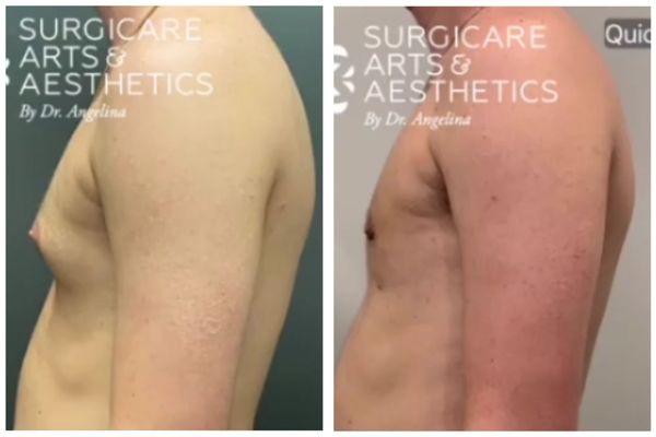 Vaser lipo gynecomastia before and after - side view