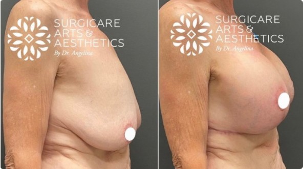 Breast Lift + implant