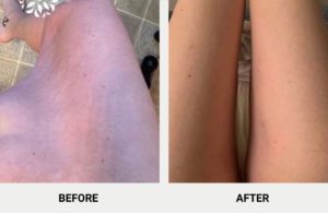 inner thigh lift results