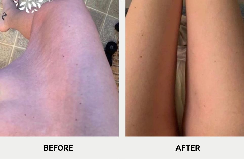 inner thigh lift results