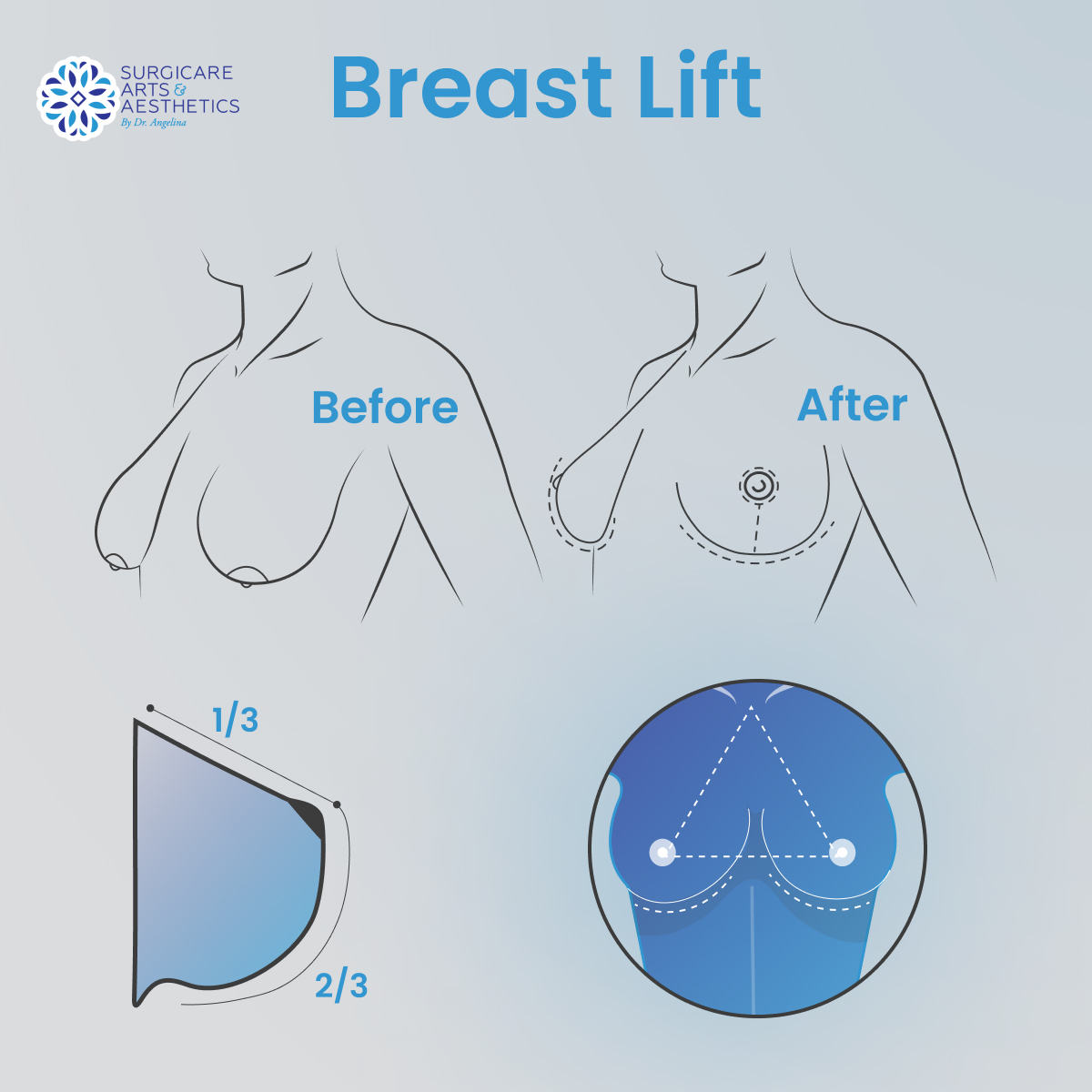 Breast lift infographic