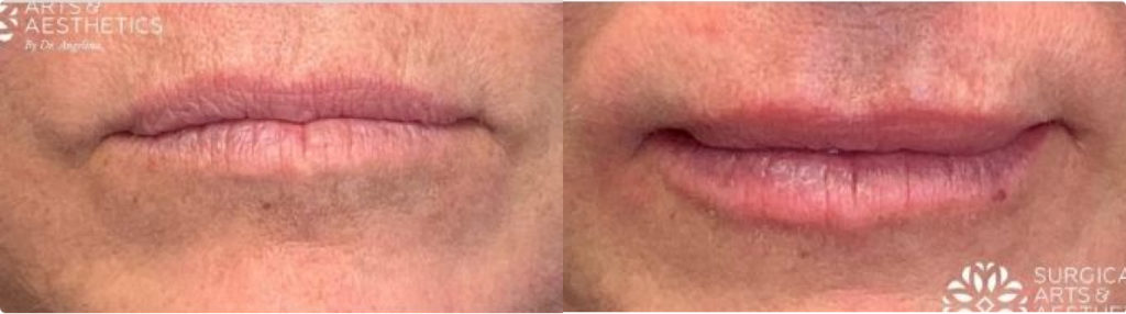 Vollure Lips Before And After