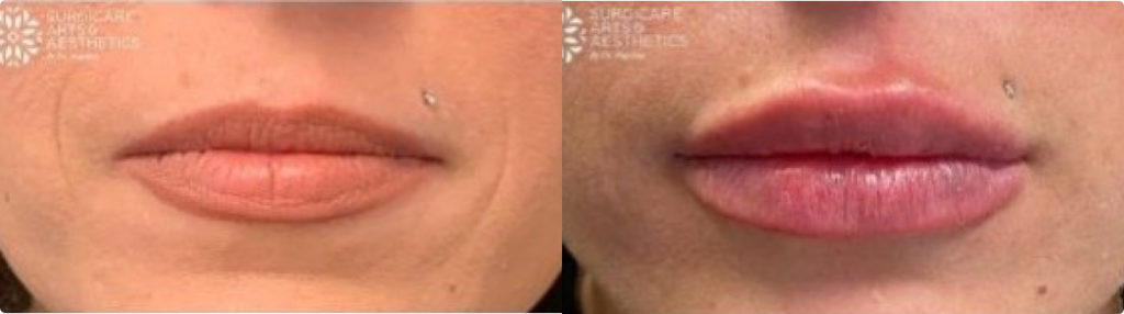 Juvederm Vollure Lips Before And After