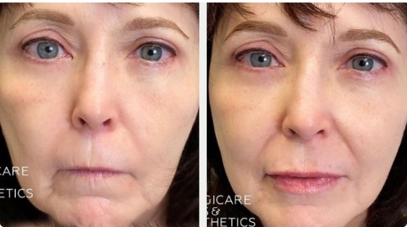 Juvederm Vollure Before And After