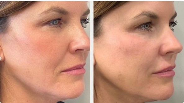 Juvederm Voluma Cheeks Before and After