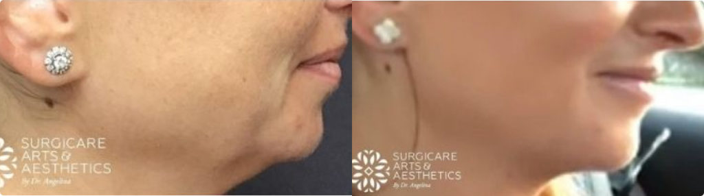 Juvederm Voluma Chin Before And After