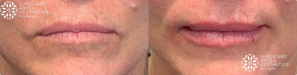 Juvederm Vouma Before And After Lips