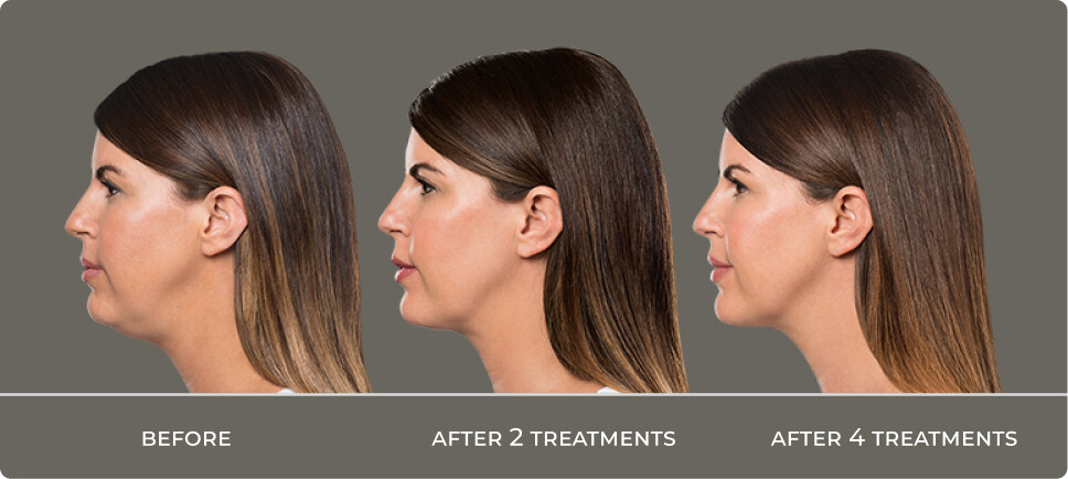 Kybella Before And After - Chin