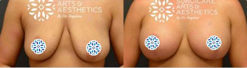 Breast Lift Before And After - Large Breasts