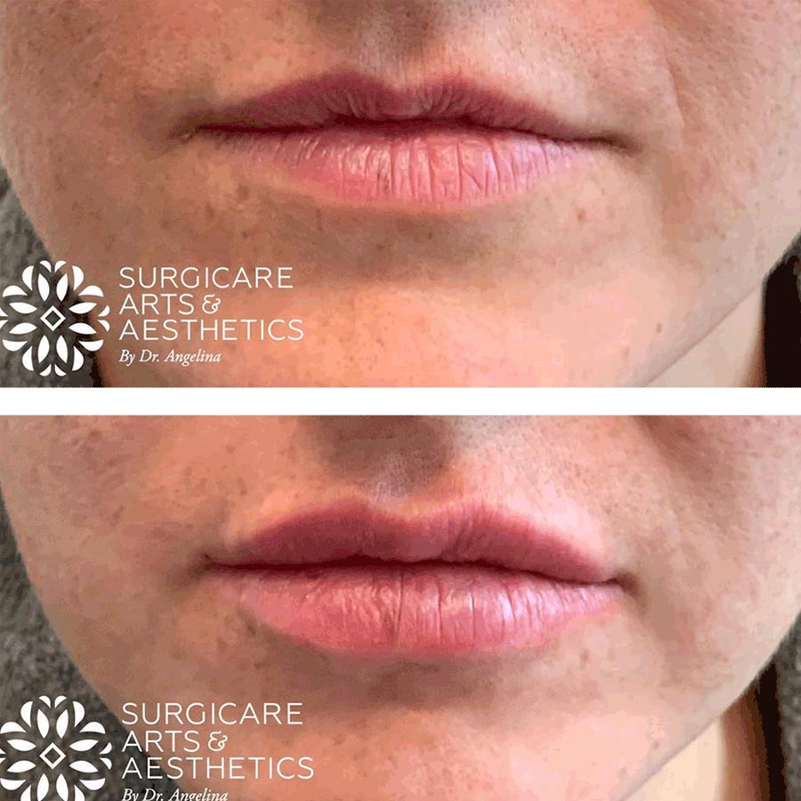 juvederm volbella lips before and after