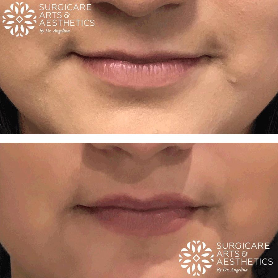 volbella lips before and after