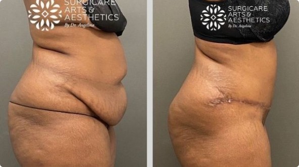 Before And After Liposuction With Tummy Tuck side view