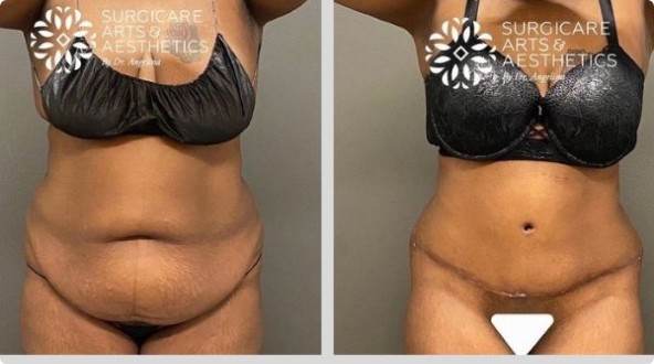 Before And After Liposuction With Tummy Tuck