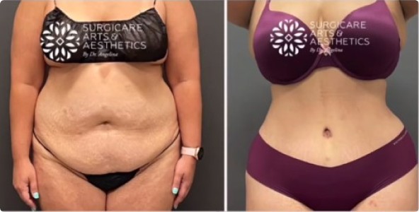 Tummytuck and liposuction on the waist and stomach - before and after