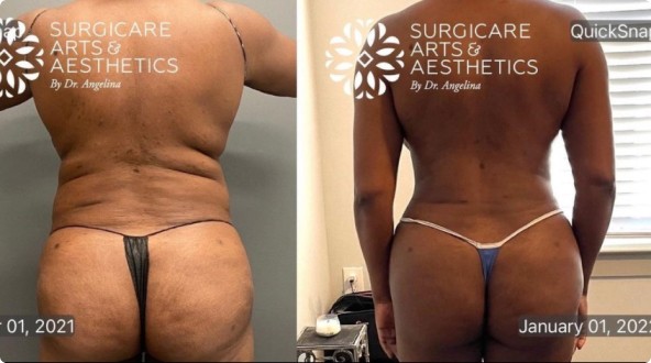 Liposuction with BBL for an hourglass figure