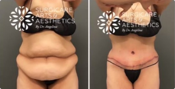 Liposuction Before and After – Pictures After 1 Week and 1 Month