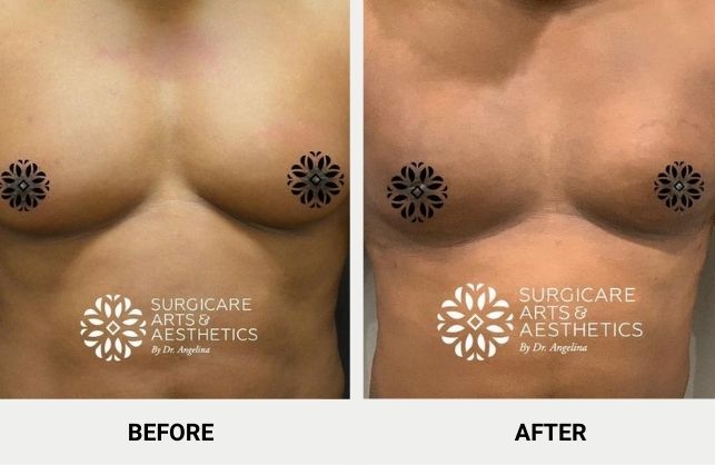 male breast reduction with bodytite