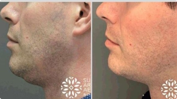 Morpheus8 for men before and after