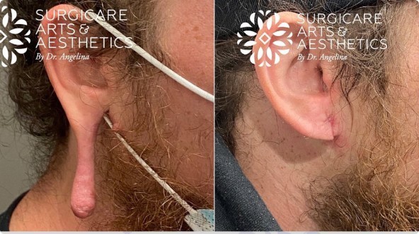 Before And After Ear Pinning