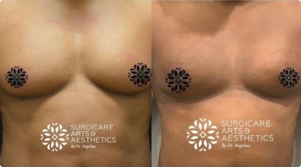 Pseudogynecomastia before and after with BodyTite