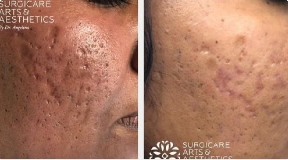 Morpheus8 for acne scars before and after