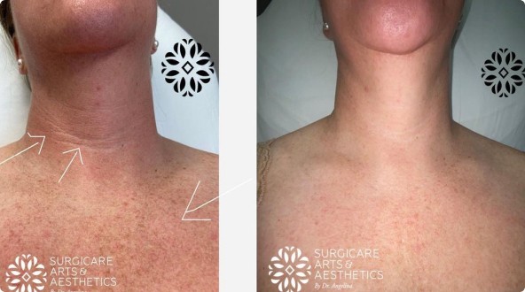 Morpheus8 for neck before and after