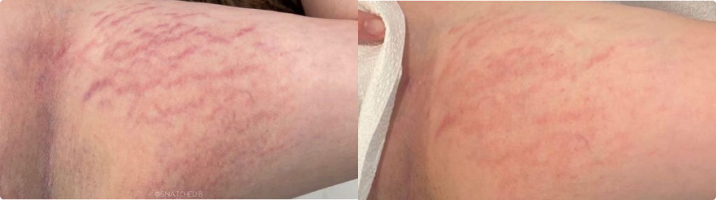 Morpheus8 stretch marks before and after