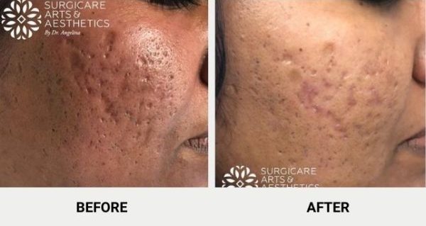Morpheus8 for acne scars before and after