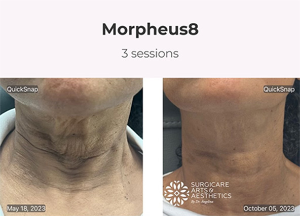 Morpheus8 before and after neck